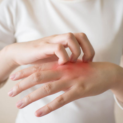 Woman scratching skin on her hands